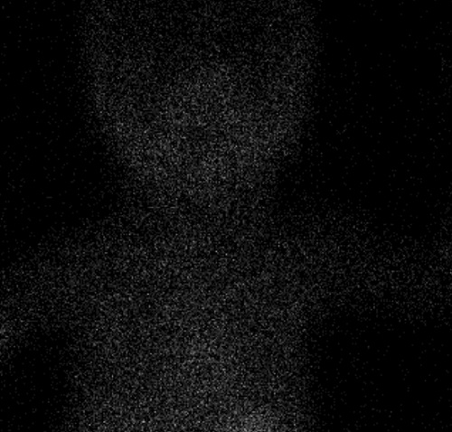 Figura 1. Gammagrafía tiroidea en la que se observa disginesia tiroidea