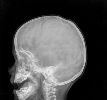 Figura 1. Radiografía donde se observa una línea radiolúcida a nivel de la calota