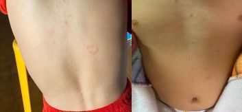 Figura 1. Lesiones en el tronco