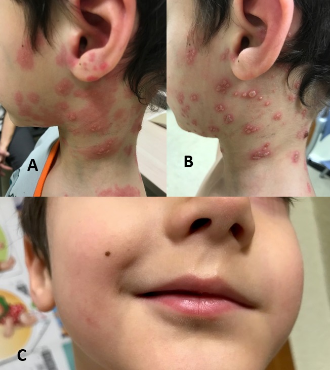 Figura 1. A: momento inicial. B: al segundo día. C: desviación de la comisura bucal al tercer día.