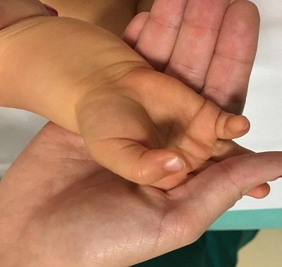 Figura 1. Afectación palmoplantar