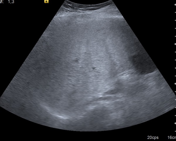 Figura 1. Ecografía abdominal con parénquima hepático con aumento de ecogenicidad