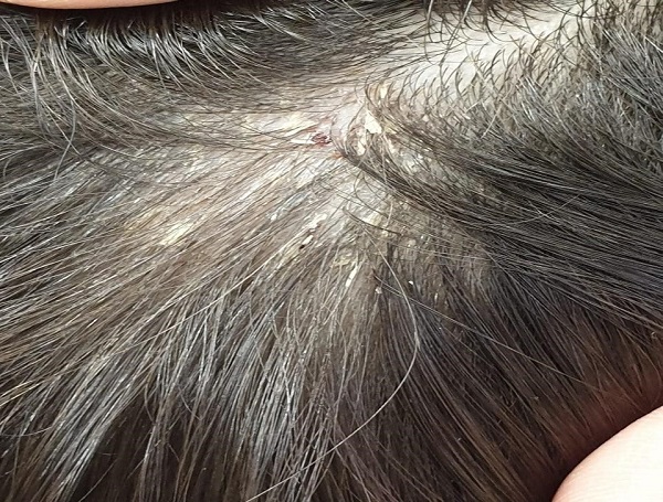 Figura 2. Evolución de las lesiones