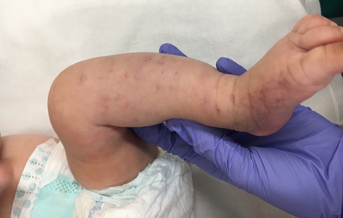 Figura 1. Lesiones petequiales en el miembro inferior izquierdo