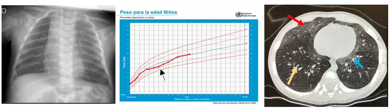 Figura 1. A: izquierda. Radiografía de tórax, en la que no se observaron hallazgos patológicos. B: centro. Curva de crecimiento del paciente en comparación con percentiles de la OMS, donde se observa un leve estancamiento ponderal durante el proceso (flecha). C: derecha. TACAR donde se pueden apreciar áreas en vidrio deslustrado en lóbulo medio (flecha roja) y língula, patrón y localización típicos de esta entidad, y regiones paramediastínicas altas (flecha azul), intercalados con áreas de menor densidad radiológica (flecha amarilla), propias de un patrón parcheado