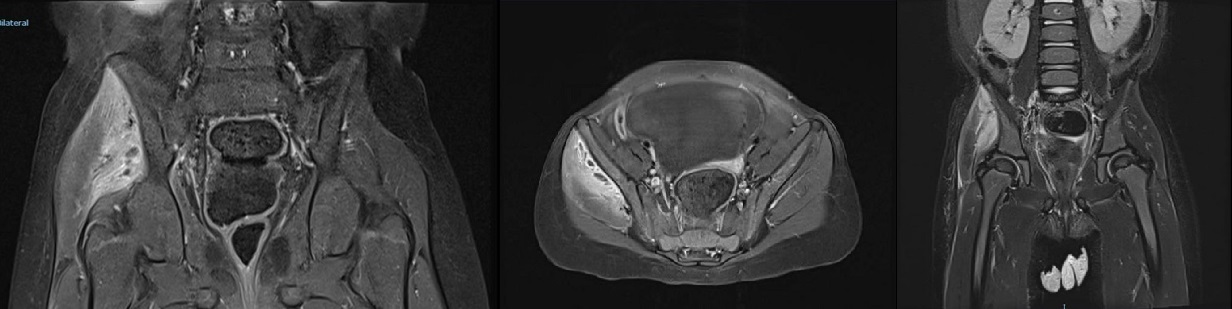 Figura 1. Ilustración SEQ Ilustración\* ARABIC 1. Imágenes de resonancia magnética que muestran hiperintensidad a nivel de glúteo menor y medio derechos, con captación de contraste en la zona y pequeñas colecciones compatibles con abscesos intramusculares.