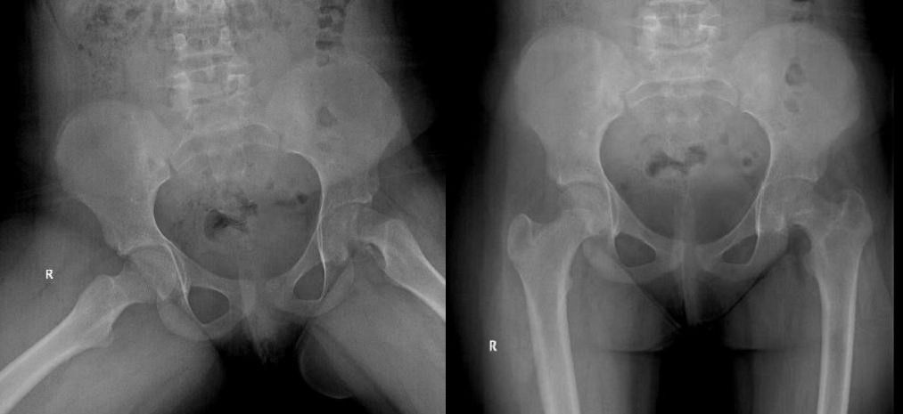 Figura 1. Desplazamiento inferior de la epífisis respecto a la metáfisis