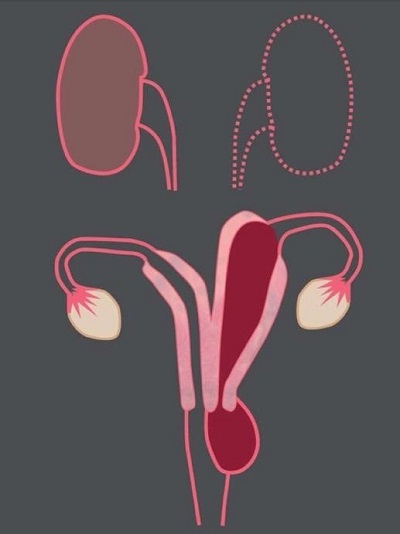 Figura 3. Síndrome de Herlyn-Wermer-Wunderlich 