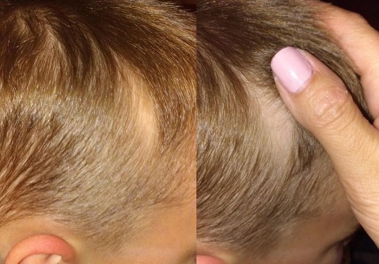 Figura 1. Alopecia triangular congénita