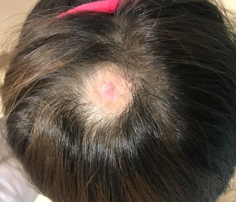 Figura 1. Placa alopécica residual tras mordedura de garrapata