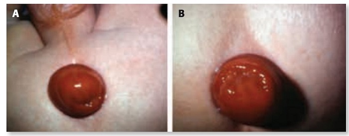 Figura 2. Prolapso rectal. Nótese la diferencia con la Fig. 1. Mucosa rojiza, con orificio central