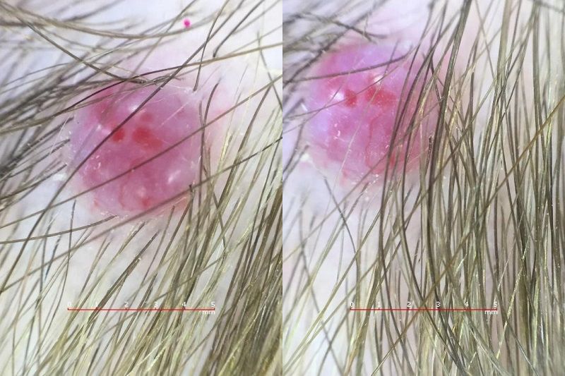 Figura 2. Imagen dermatoscópica de granuloma piógeno