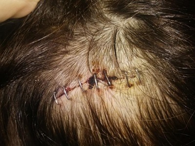 Figura 3. Resección de la lesión