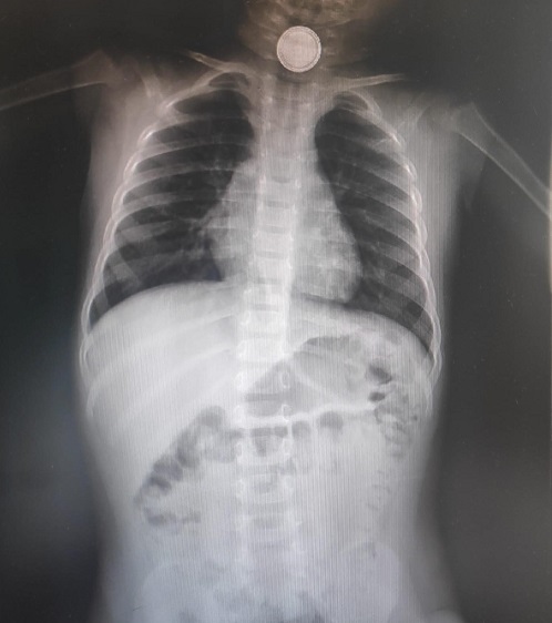 Figura 1. Medición del diámetro corneal
