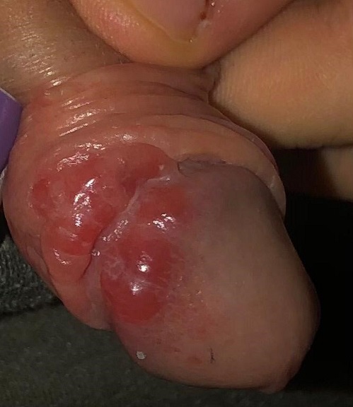 Figura 1. Lesión balano-prepucial