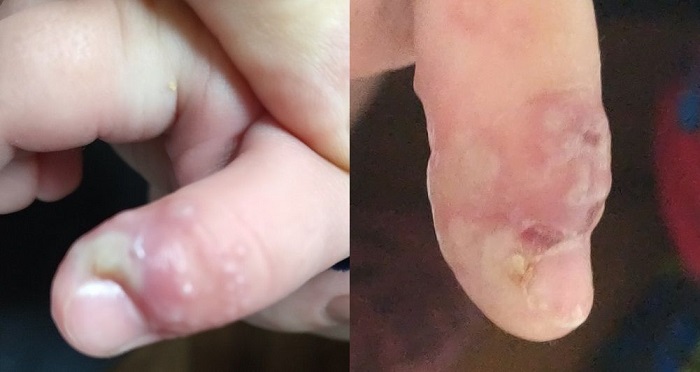 Figura 1. Lesiones vesiculosas compatibles con panadizo herpético