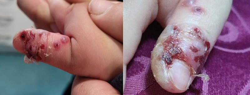 Figura 2. Panadizo herpético evolucionado con lesiones vesiculosas en distintas fases evolutivas, varias de ellas con costras hemorragias tras haber supurado contenido hemático 