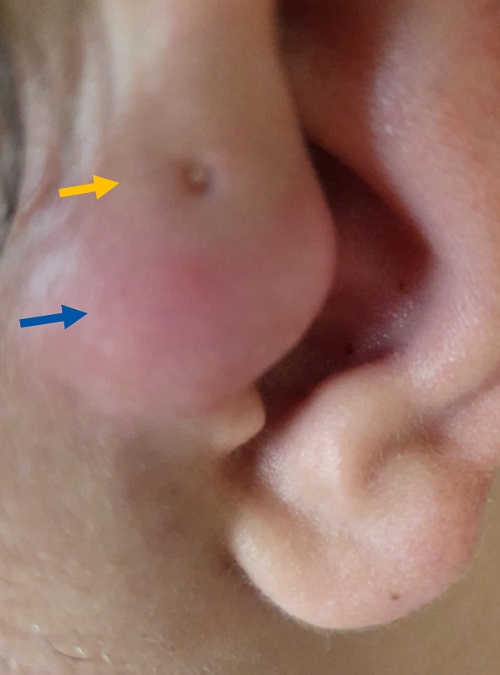Figura 1. Fístula preauricular (flecha amarilla) y bultoma en región adyacente a la fístula (flecha azul)
