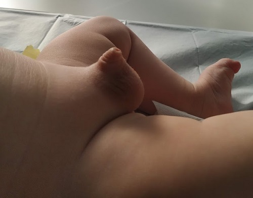 Figura 1. Prepucio redundante y abultado