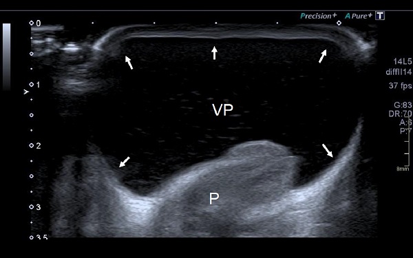 Figura 2. Vejiga prepucial llena de orina, anecoica (VP). Piel del prepucio (flechas). Pene (P)