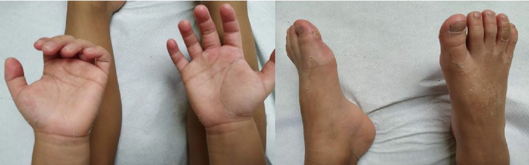 Figura 1. Descamación palmoplantar