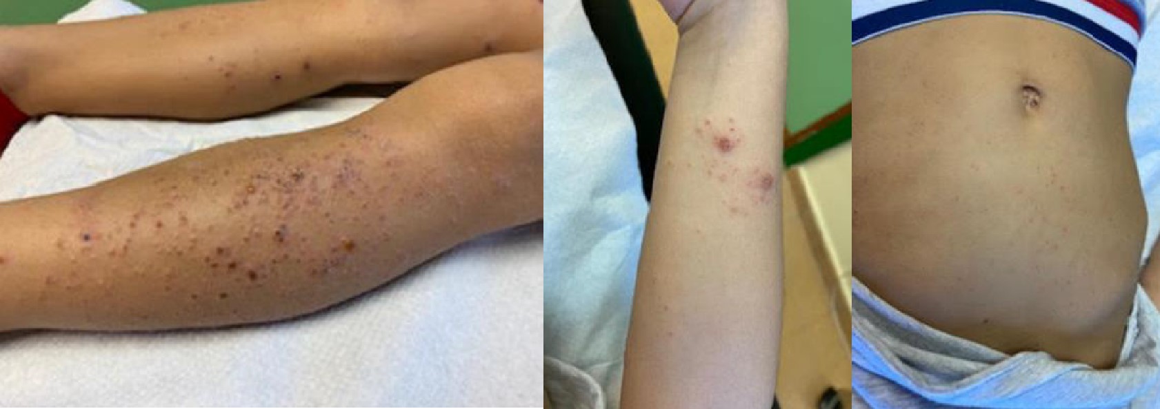 Figura 2. Lesiones maculopapulosas junto a vesículas con costras