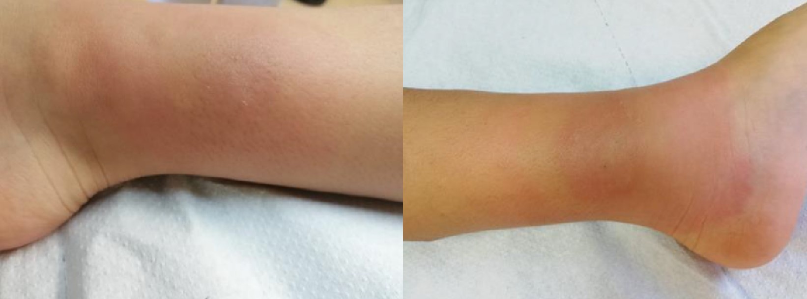 Figura 3. Placas eritematosas e induradas