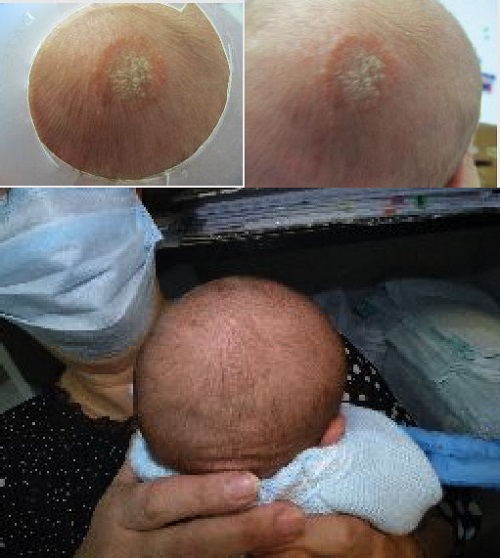 Figura 1. Lesión de bordes eritematosos sobreelevados