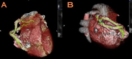 Figura 2. Angiotomografía en la que se observa MAVP