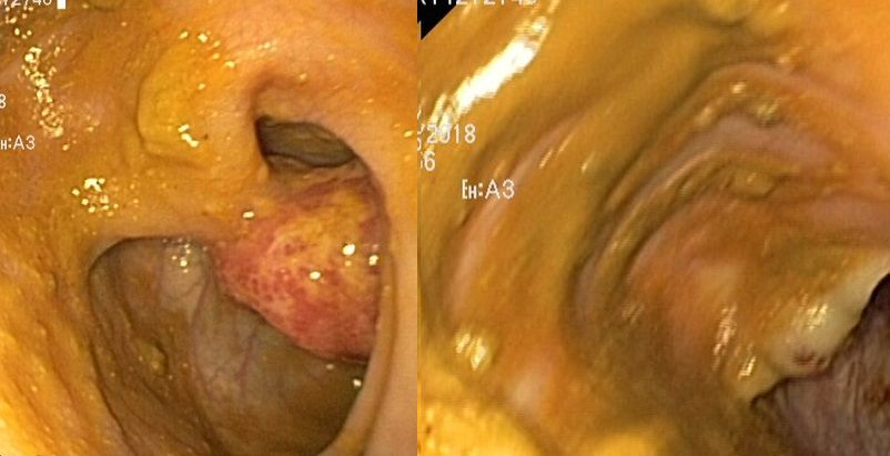 Figura 1. Imágenes de colonoscopio