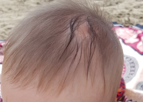 Figura 1. Plata eritematosa, marronácea, descamativa, en la zona parietal.