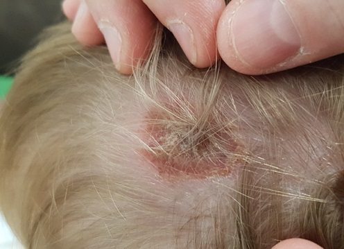 Figura 2. Estado de lesión al inicio del tratamiento con imiquimod 