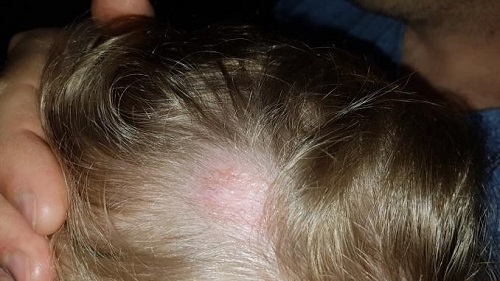 Figura 3. Placa alopécica residual tras tratamiento con antimoniales intralesionales e inmunomodulador tópico