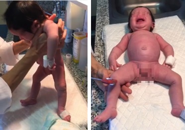 Figura 1. A: hipotonía axial observada con la maniobra de suspensión vertical. B: postura en libro abierto, ausencia de movilidad espontánea de miembros superiores con ROT débiles