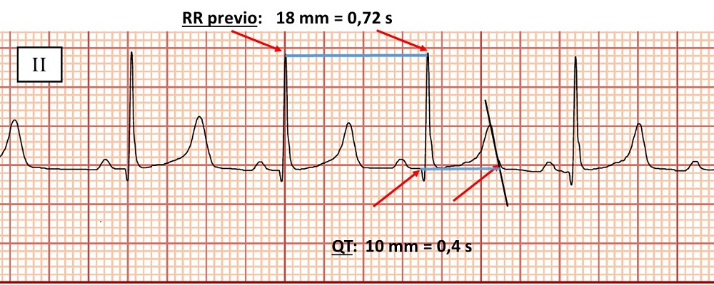 Figura 2. Medición de intervalos QT y RR previo