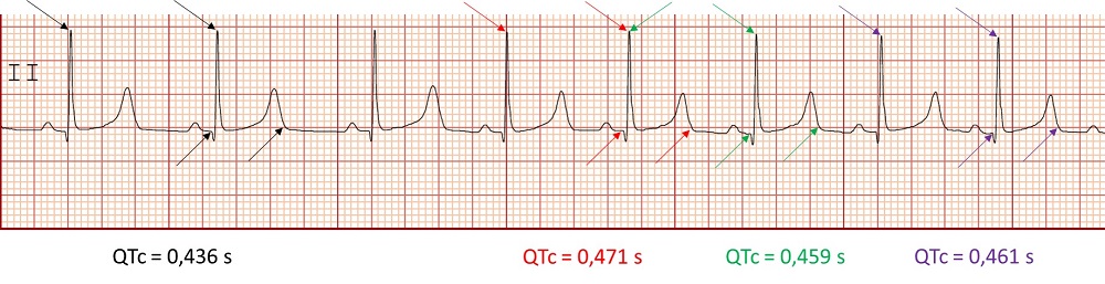 Figura 3. Medición de varios QTc y su media. QTc medio 0,456 s