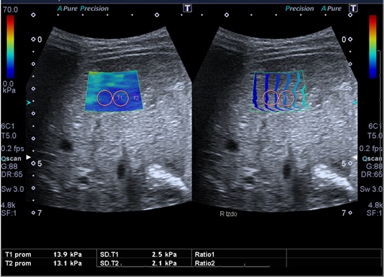 Figura 1. Ecografía con elastografía. La “rigidez” del hígado evaluado se expone a través de un código de colores