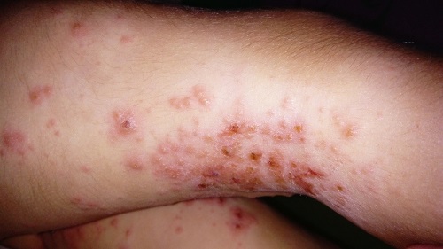 Figura 1. Eccema <em>herpeticum</em>: pápulas, lesiones costrosas y vesículas en áreas de flexión de extremidades inferiores.