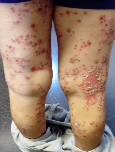 Figura 2. Eccema <em>herpeticum</em>: extensión de las lesiones, más allá de áreas de flexión, en fase costrosa, a las 48 horas de iniciado el cuadro.