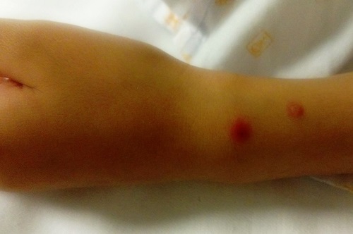 Figura 2. MIRM: lesiones vesiculares sobre base eritematosa en antebrazo