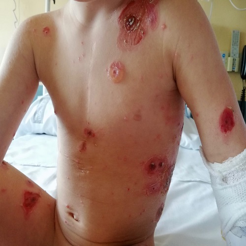 Figura 1. Lesiones de distinta morfología y diferente estado evolutivo. Presenta lesión ampollosa de 2 cm de diámetro en tórax superior, lesiones exudativas y costrosas de hasta 5 cm en el tronco, así como lesiones vesiculares de 3-5 mm 