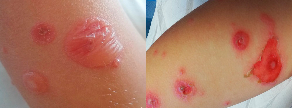 Figura 2. Izquierda: lesiones ampollosas flácidas entre 1-2 cm en distinto estadio evolutivo con pápula central. Vesícula de pequeño tamaño adyacente a lesión de mayor tamaño. Derecha: lesiones exudativas eritematosas por el desprendimiento de la ampolla previa