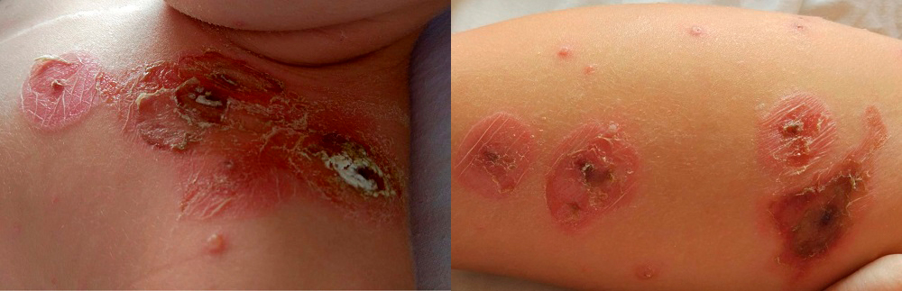 Figura 3. Lesiones ampollosas en fase de resolución en la zona superior del tórax (izquierda) y el miembro inferior derecho (derecha). Existen lesiones eritematosas descamativas, así como lesiones costrosas negruzcas. Además, presenta lesiones vesiculares de 3-5 mm 