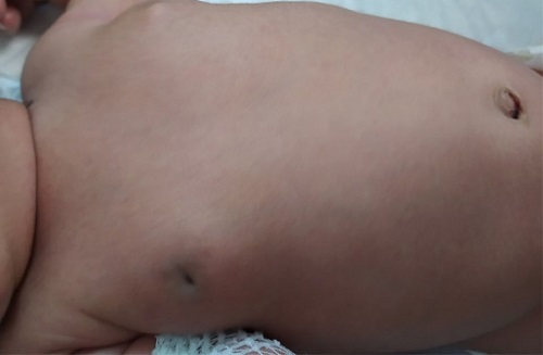 Figura 1. Intumescencia mamaria neonatal de gran tamaño