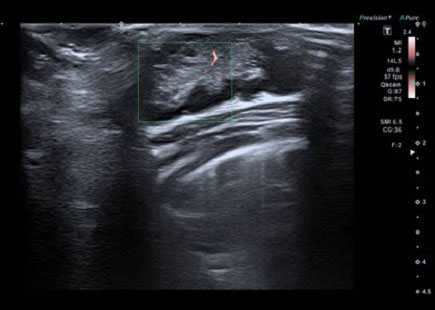 Figura 4. Ecografía Doppler: glándula mamaria derecha en la que no se observa aumento significativo del flujo Doppler. No se observa vacularización interna 