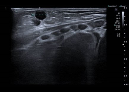Figura 5. Ecografía: quiste mamario izquierdo de 7 mm, anecoico, que protruye sobre superficie cutánea, sin aumento de la vascularización periférica 