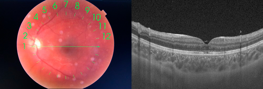 Figura 2. Exploración a los seis meses. Se aprecia retina reaplicada en el polo posterior