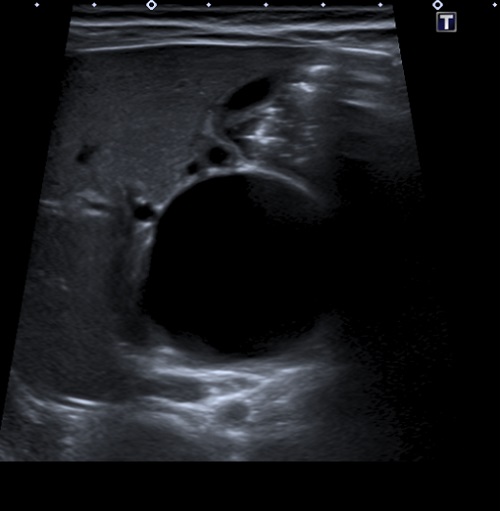 Figura 1. Ecografía. Marcada dilatación del colédoco, de morfología quística
