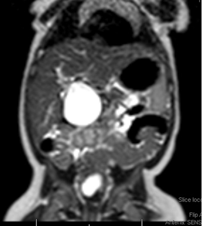 Figura 2. Colangiorresonancia magnética. Lesión quística bien definida, amplia, y redondeada del conducto colédoco en su totalidad