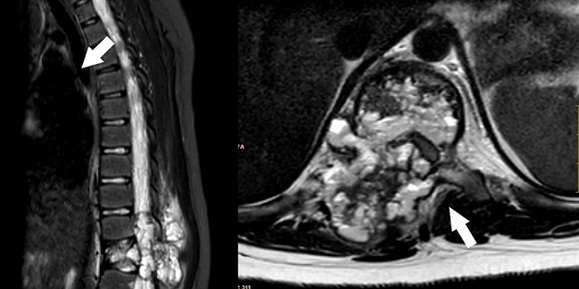 Figura 2. RM de columna vertebral: masa lobulada insuflante en elementos posteriores de T10 que se introduce anteriormente hacia el cuerpo vertebral, rodeada de cortical ósea marcadamente adelgazada con múltiples niveles líquido-líquido junto con alteración de la señal de la musculatura paravertebral derecha por edema asociado (flechas). Asocia componente epidural en canal medular con compresión medular, ocupando el 50-75% de su totalidad